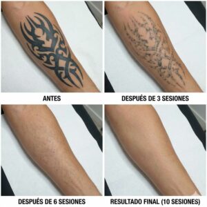 Eliminación de Tatuajes con Láser