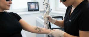 Eliminación de Tatuajes con Láser
