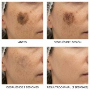 Eliminación de Manchas en la Piel con Láser en Sevilla