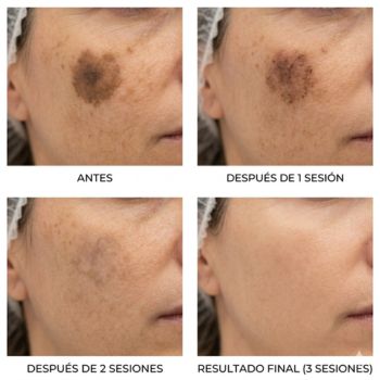 Eliminación de Manchas en la Piel con Láser en Sevilla