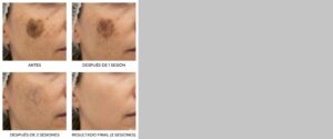 antes-y-despues-eliminacion-manchas-solares-laser-3-sesiones